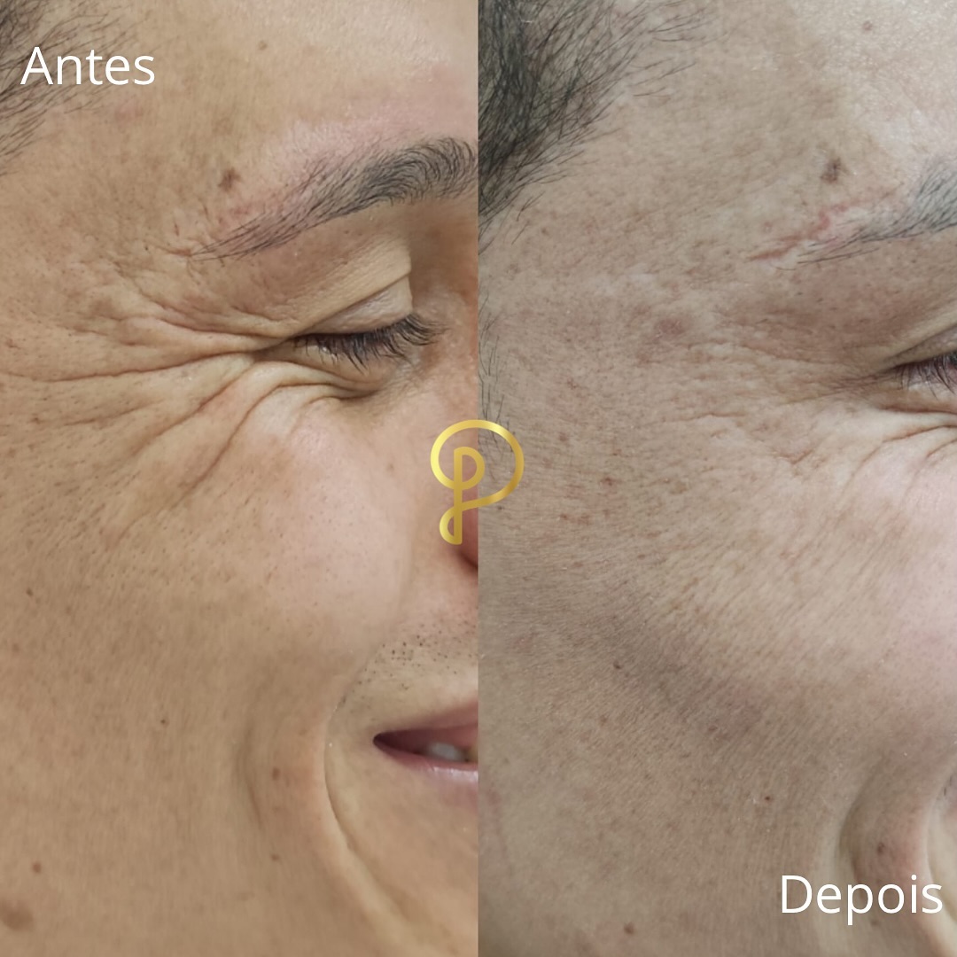 Antes e depois de tratamento nos pés de galinha, paciente da Pelíssima Clinic