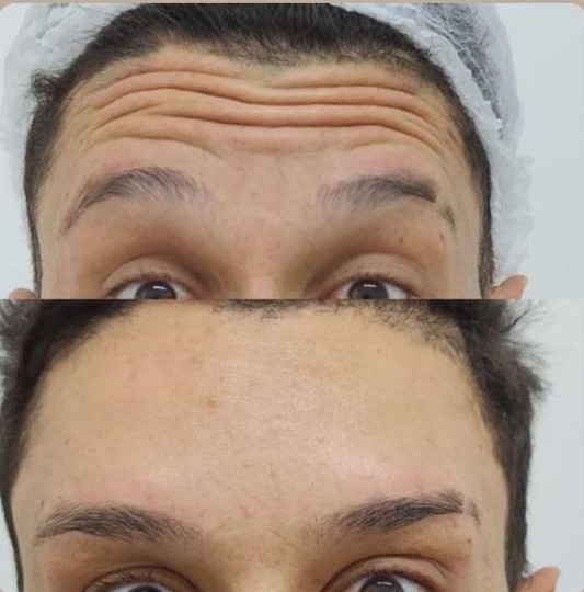 Antes e depois de tratamento nas linhas da testa, paciente da Pelíssima Clinic