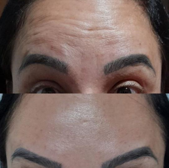 Antes e depois de tratamento nas linhas da testa, paciente da Pelíssima Clinic